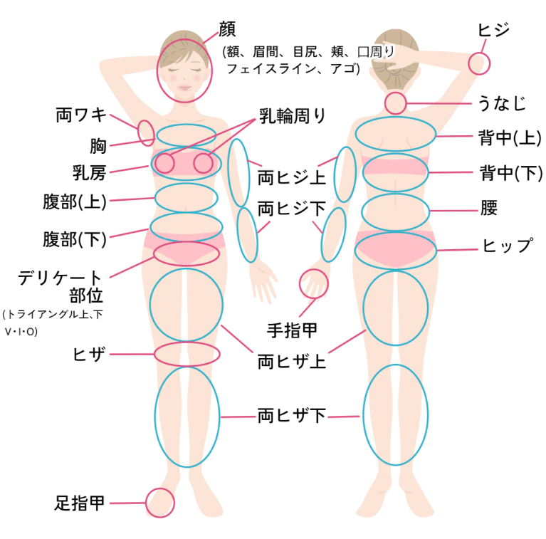 脱毛（女性）の部位を示した画像