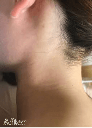 うなじ脱毛のafter写真