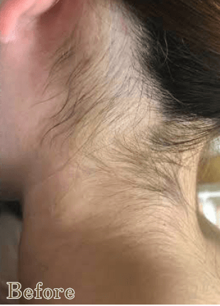うなじ脱毛のbefore写真